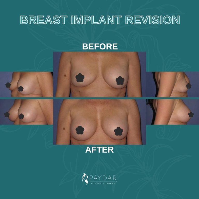 graphic with before and after breast augmentation on female patient at Paydar Plastic Surgery