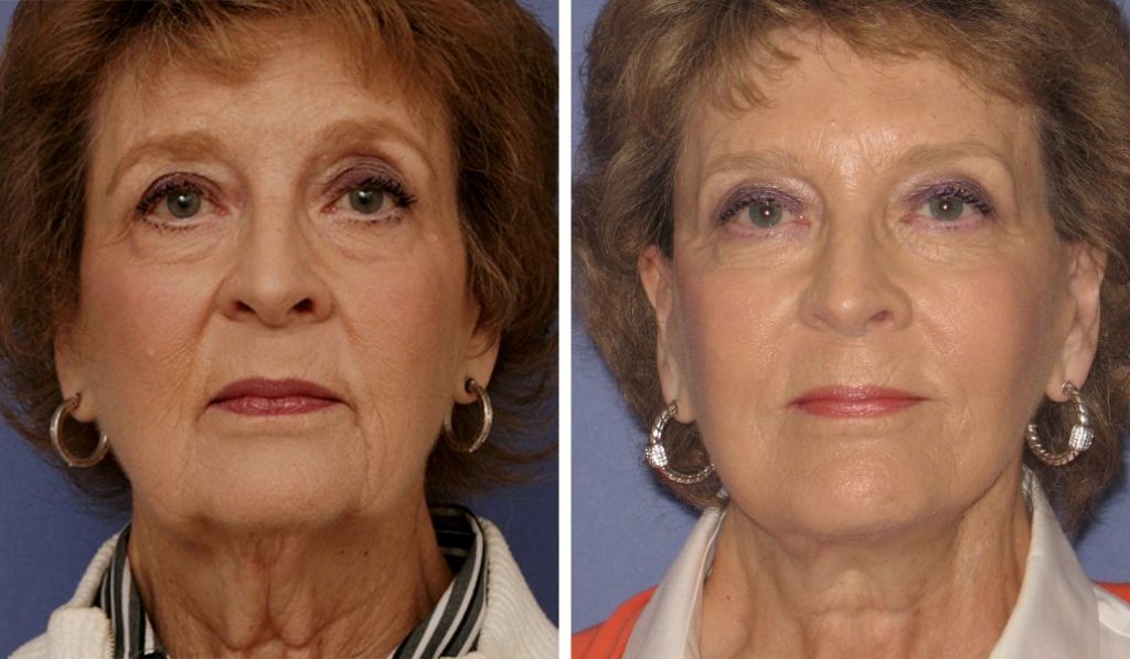 Facelift in Newport Beach