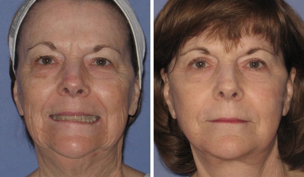before & after facelift female patient front view