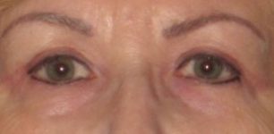 after Blepharoplasty / Eyelid Surgery zoomed front view Case 1630