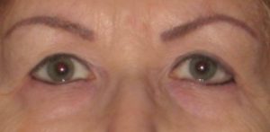 before Blepharoplasty / Eyelid Surgery zoomed front view Case 1630