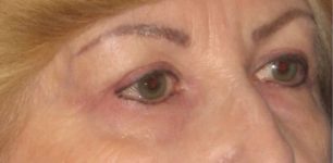 after Blepharoplasty / Eyelid Surgery zoomed diagonal view Case 1630