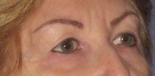 before Blepharoplasty / Eyelid Surgery zoomed diagonal view Case 1630