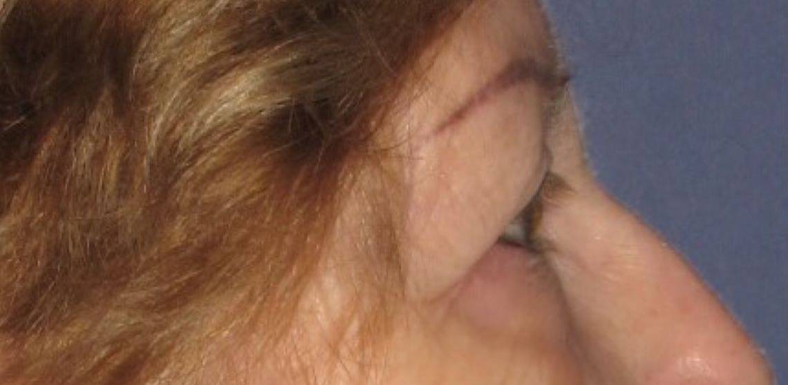 before Blepharoplasty / Eyelid Surgery zoomed side view Case 1630
