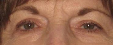 after Blepharoplasty / Eyelid Surgery zoomed front view Case 1637