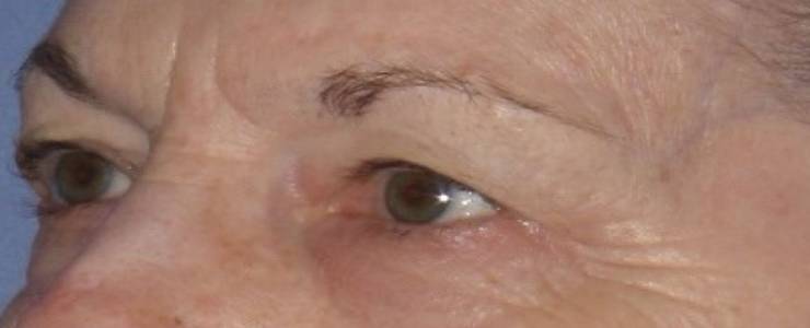 before Blepharoplasty / Eyelid Surgery zoomed diagonal view Case 1637
