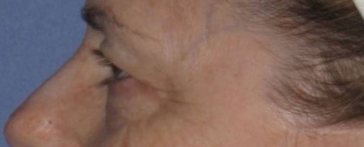 before Blepharoplasty / Eyelid Surgery zoomed side view Case 1637