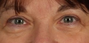 after Blepharoplasty / Eyelid Surgery zoomed front view Case 1644