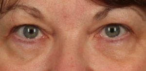 before Blepharoplasty / Eyelid Surgery zoomed front view Case 1644