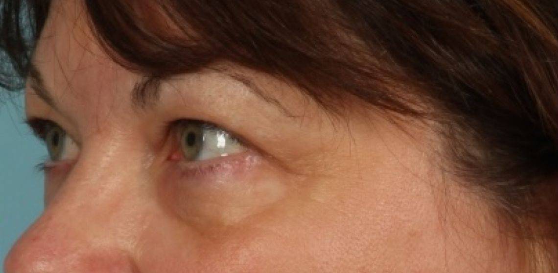 before Blepharoplasty / Eyelid Surgery zoomed diagonal view Case 1644