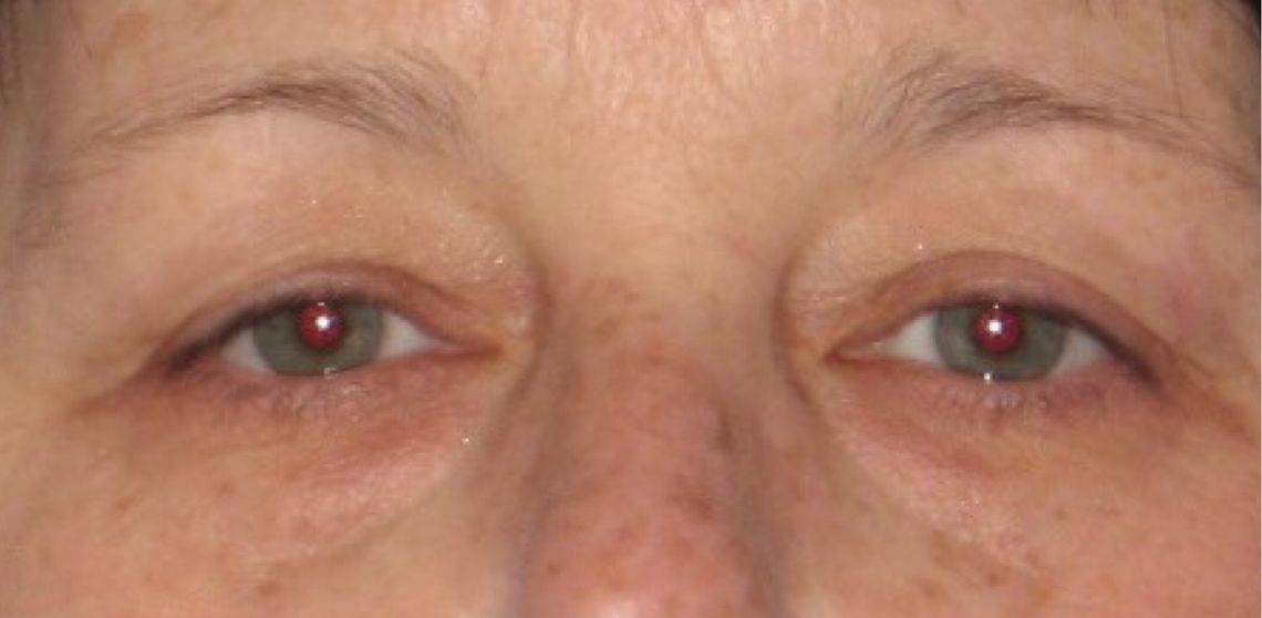before Blepharoplasty / Eyelid Surgery zoomed front view Case 1651