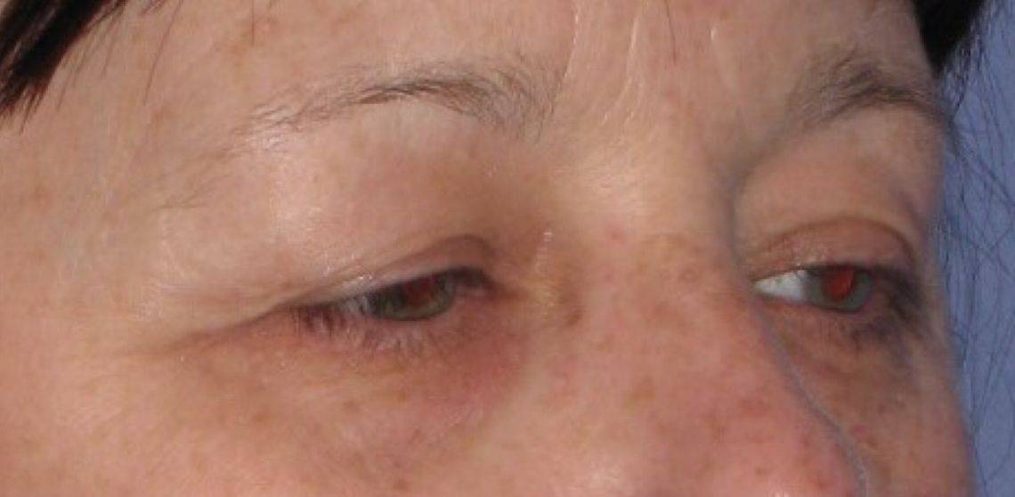 before Blepharoplasty / Eyelid Surgery zoomed diagonal view Case 1651