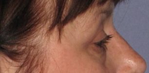 after Blepharoplasty / Eyelid Surgery zoomed side view Case 1651