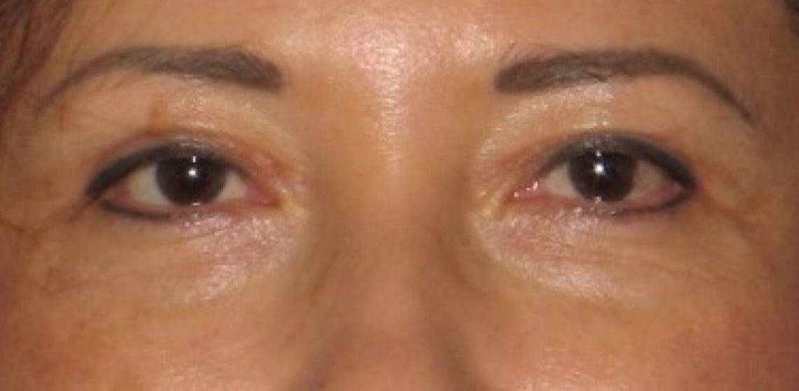after Blepharoplasty / Eyelid Surgery zoomed front view Case 1658