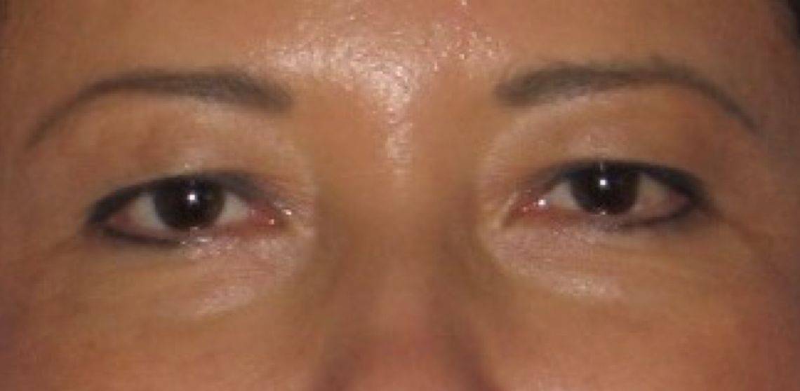 before Blepharoplasty / Eyelid Surgery zoomed front view Case 1658