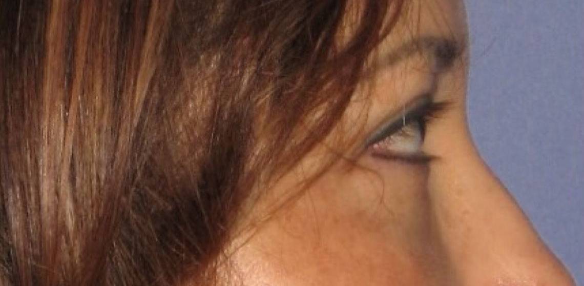 after Blepharoplasty / Eyelid Surgery zoomed side view Case 1658