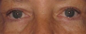 after Blepharoplasty / Eyelid Surgery zoomed front view Case 1666