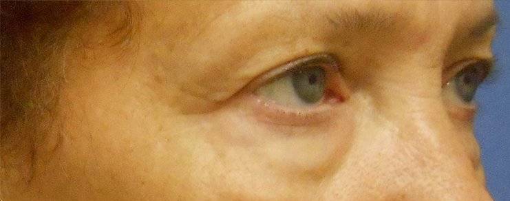 before Blepharoplasty / Eyelid Surgery zoomed diagonal view Case 1666