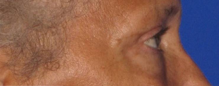 after Blepharoplasty / Eyelid Surgery zoomed side view Case 1666