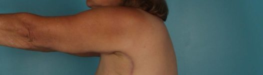 after Brachioplasty / Arm Lift left arm view Case 1680