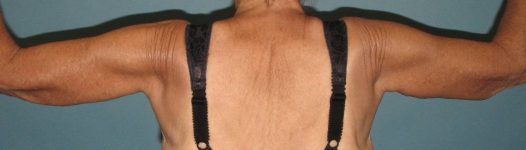 after Brachioplasty / Arm Lift back view Case 1708