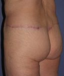 after butt lift angle view female patient case 1209