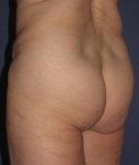 before butt lift angle view female patient case 1209