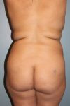 before butt lift back view female patient case 1223