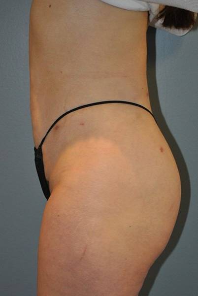 after butt lift side view female patient case 1244