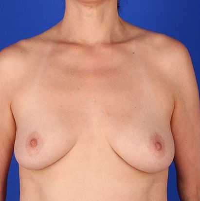 before breast augmentation front view case 1231