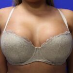 after breast augmentation front view case 1290