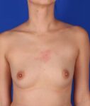 before breast augmentation front view case 1365