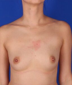 Patient Breast Augmentation Before 0