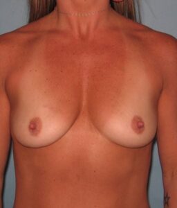 Patient Breast Augmentation Before 0