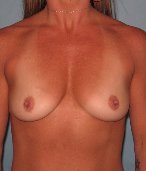 before breast augmentation front view Case 1390