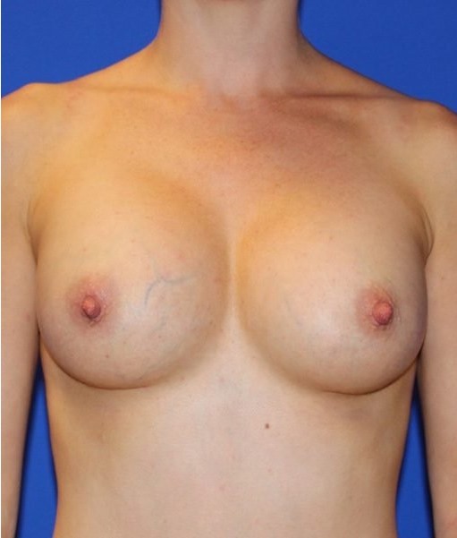 after breast augmentation front view Case 1397