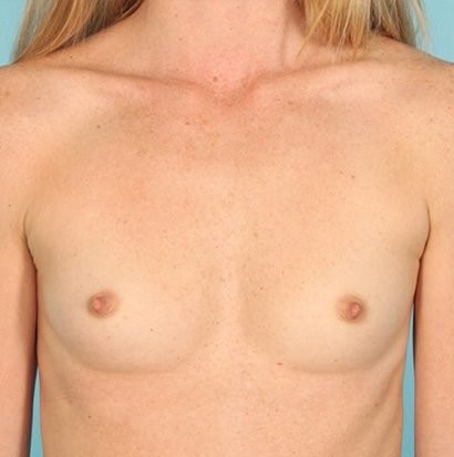 before breast augmentation front view Case 1404