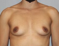 before breast augmentation front view Case 1446