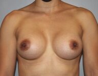 after breast augmentation front view view Case 1446