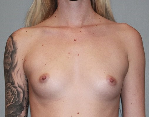 before breast augmentation front view Case 1453