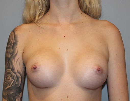 after breast augmentation front view Case 1453