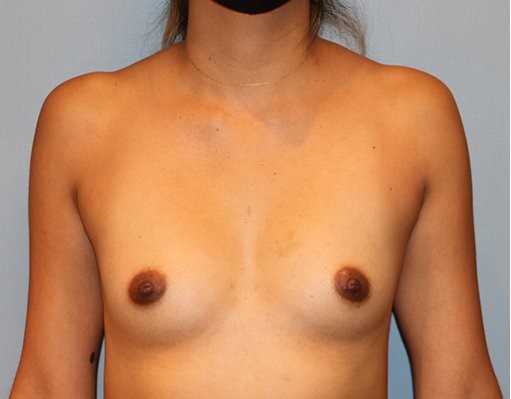 before breast augmentation front view Case 1469