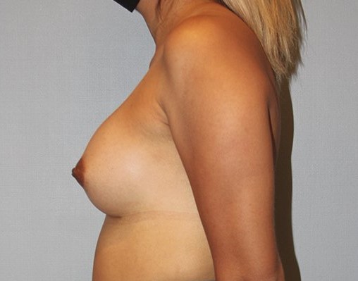 after breast augmentation side view 1469
