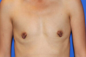 Patient Breast Augmentation Before 0