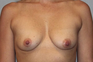 Patient Breast Augmentation Before 0