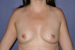 Patient Breast Augmentation Before 0