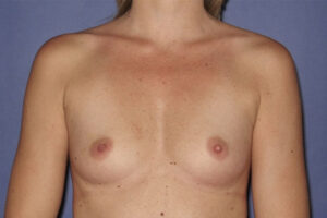 Patient Breast Augmentation Before 0