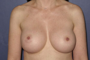 Patient Breast Augmentation After 0