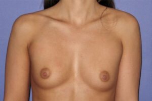 Patient Breast Augmentation Before 0