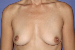 Patient Breast Augmentation Before 0